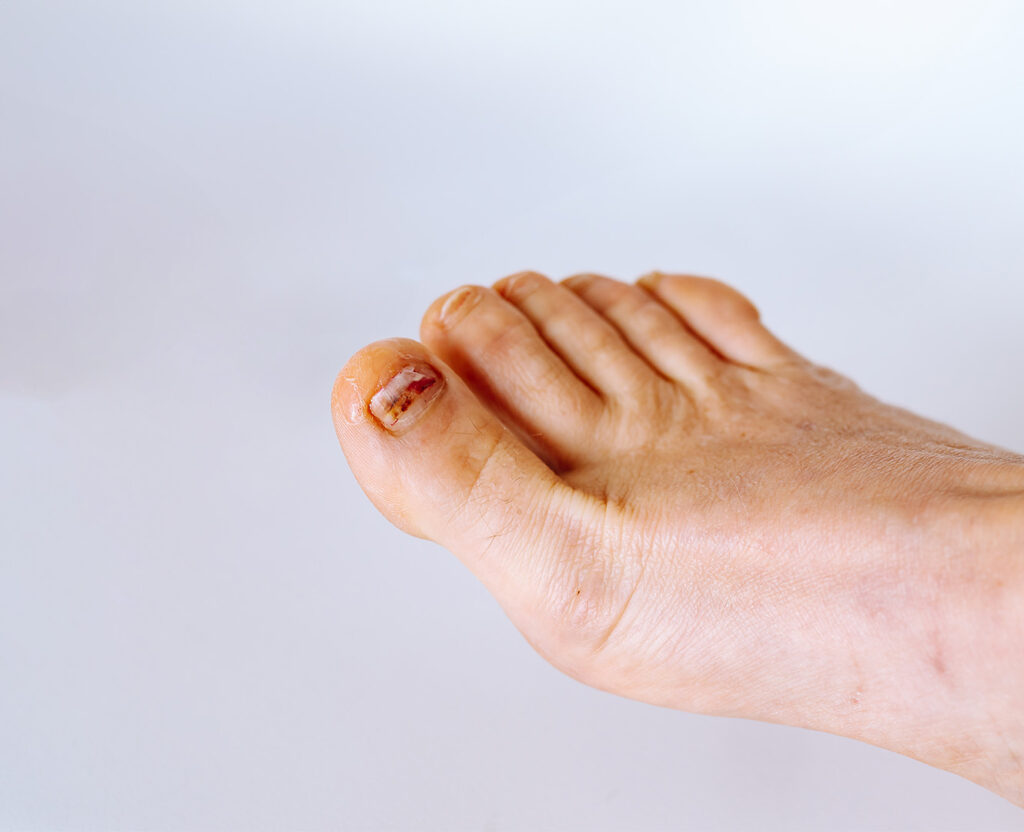 Nail Fungus Treatment