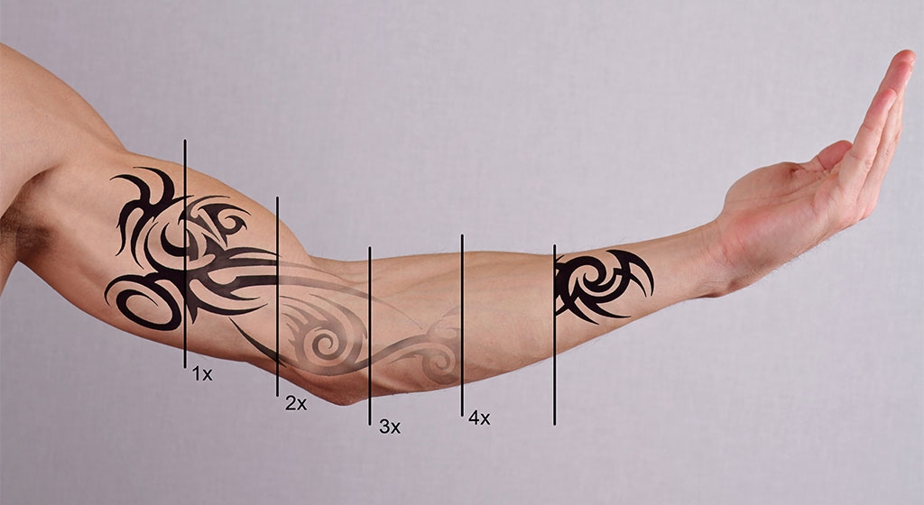 Tattoo Removal