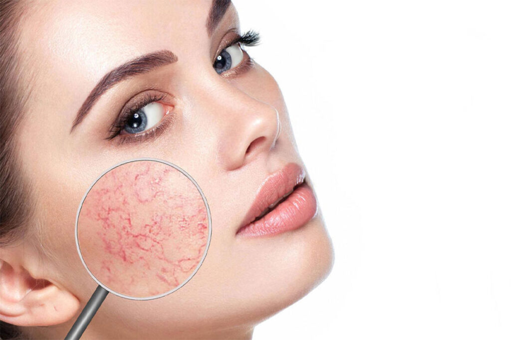 Fractional Carbon Dioxide Laser