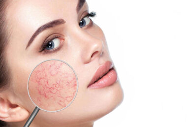 Fraksiyonel Karbondioksit Lazer