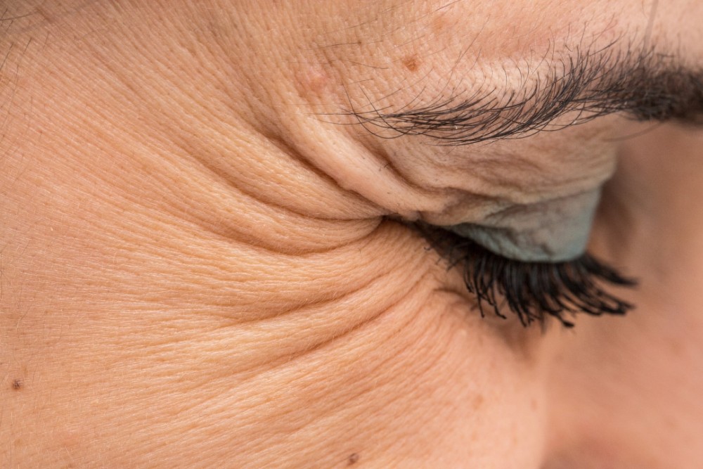 Göz Çevresi Kırışıklıkları