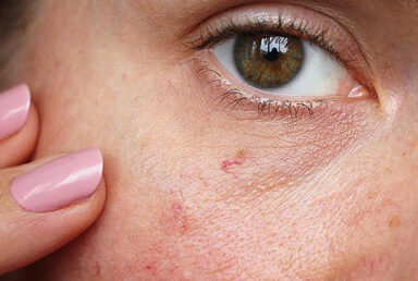 Lazerle Kilcal Damar Tedavisi