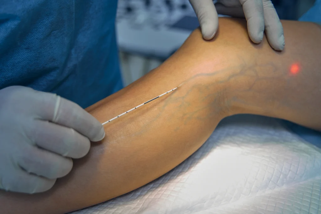 Laser Varicose Vein Treatment